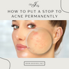 How To Put a Stop to Acne Permanently